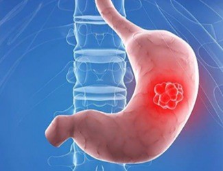 你知道嗎？從慢性胃炎到胃癌，只有四步！